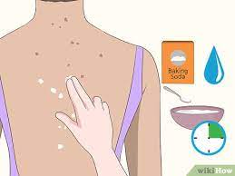Red scars, black scars, or bumpy scars are all treated differently. 3 Ways To Get Rid Of Back Acne Scars Wikihow
