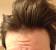 Frontal Hair Loss Female