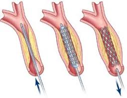 Pin By Carolina Vascular Surgery Di On Vascular Surgery Vascular Vascular Surgery Carotid Artery
