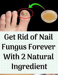 A Fungal Nail Occurs When A Fungus Attacks A Toenail A Fingernail Or The Skin Under The Nail Any Part Toe Fungus Remedies Nail Fungus Toenail Fungus Remedies