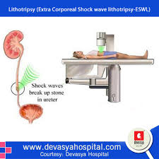 Eswl Is Highly Effective For Soft Kidney Stone Of About 1cm Most Of The People Understand Lithotripsy As Laser Treatment Bu Laser Treatment Shock Wave Hospital