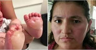 La varicela se caracteriza típicamente por la aparición de ampollas rojas que pican en todo el cuerpo, incluidos los pies. La Mama Ve Grandes Ampollas En Los Pies Del Bebe Queda En Shock Cuando Descubre La Verdad