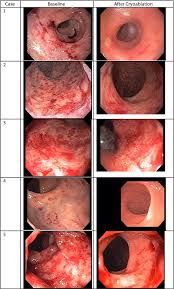 Image result for Radiation Colitis