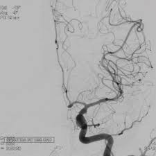See more of aneurisma on facebook. Tratamento Endovascular De Aneurisma Roto Do Tipo Blister Com Stent Redirecionador De Fluxo Pipeline Shieldagosto 2020 Angiorad