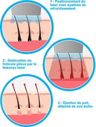 Où se faire épiler ? Epilation Laser Clinique Esthetique Phenicia Marseille