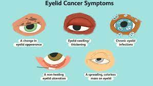 Dry skin on eyelids may be an indication of various conditions including dermatitis (eczema). Eyelid Cancer Overview And More