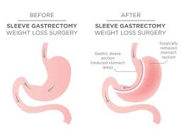 Gastric Sleeve Surgery Can Be A Great Tool Against Obesity When Used Correctly But It Isn T An Easy Bu Sleeve Gastrectomy Gastric Sleeve Surgery Sleeve Surgery