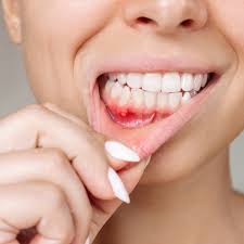 Image result for mouth ulcer on tongue)