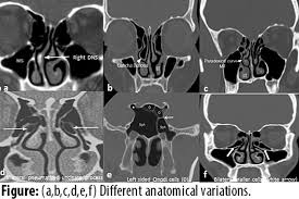 In this page, we are going to study the nose anatomy, with a special focus on the anatomical importance of the nasal cavity structure. Jpma Journal Of Pakistan Medical Association