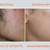The condition is most prevalent among people who have coarse or curly hair. 1