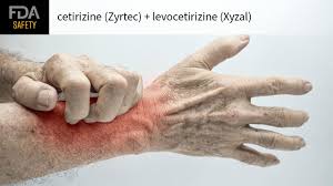 FDA Warns About Severe Itching After Stopping Popular Allergy Medications