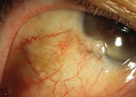 Image result for lesion sclera