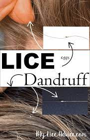 How to tell if you have lice or dandruff. Lice Eggs Dandruff And Other Dry Scalp Conditions The 7 Differences Lice Eggs Dandruff Lice Remedies