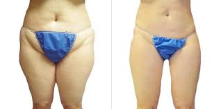 Before And After Legs Sono Bello Total Body Transformation Centers Image Source Sono Bello Website Transformation Body Liposuction Muscle Body