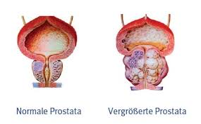Prostataerkrankungen Und Harninkontinenz Prostatabeschwerden