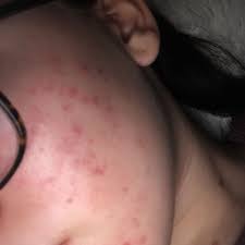 Has 5 jobs listed on their profile. Pickelmale Wegbekommen Tipps Schule Gesundheit Und Medizin Beauty