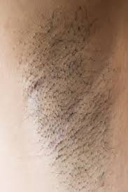 If you suspect that your ingrown hair has become infected, you may want to contact a dermatologist. Armpit Pain Common Causes And Treatments