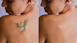 What Happens To Tattoos When You Remove Them Picosure Tattoo Removal Tattoo Removal Tattoo Removal Cost