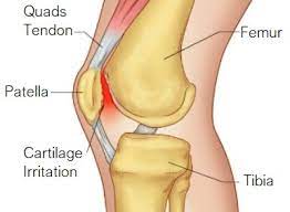 Knee Pain From Running: Causes & Treatment - Knee Pain Explained