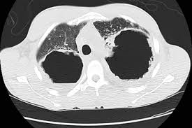 Sarcoidosis in the lungs is called pulmonary sarcoidosis. Management Of End Stage Sarcoidosis Pulmonary Hypertension And Lung Transplantation European Respiratory Society