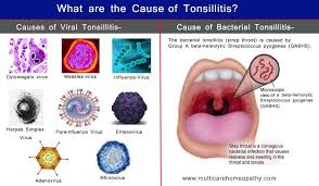 Tonsillitis can usually be treated at home. 6 Best Homeopathic Medicines For Tonsillitis Treatment