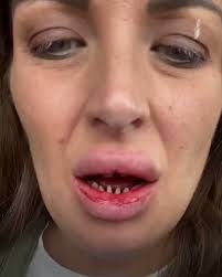 Why I Regret Turkey Teeth