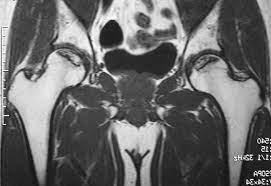 Idiopathic osteonecrosis of the femoral head; å¤§è…¿éª¨é ­å£Šæ­»ç—‡ æ…¶æ‡‰ç¾©å¡¾å¤§å­¦ç—…é™¢ Kompas