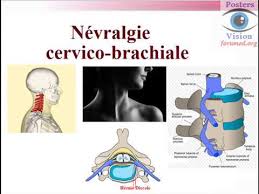 En regard de chaque disque cervical, une racine nerveuse quitte la moelle et le canal rachidien par le foramen (trou). Nevralgie Cervico Brachiale Symptomes Diagnostic Etiologies Traitement Youtube
