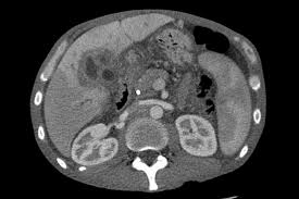 Stage b liver cancer life expectancy. Liver Cancer Wikipedia