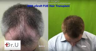 Browse the best hair transplant and hair restoration surgery results in los angeles. Why Hair Transplants Work Dermhair Clinic Los Angeles 310 318 1500