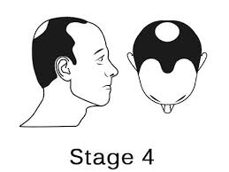 Your hair grows from the follicle or root located under the skin. Hair Transplant In Turkey Cost Calculator Check Exact Cost