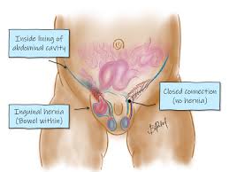 Image result for Inguinal hernia man