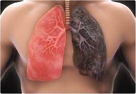 Smoking isn't the only cause of lung cancer. Non Smokers Who Develop Lung Cancer Are Hugely Disadvantaged Says Phe