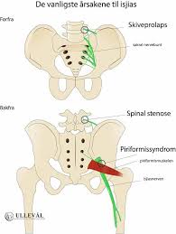 Blodpropp i dype vener kan være livsfarlige (dypvenetrombose). Vanlige Sporsmal Om Isjias Faqs Ulleval Kiropraktorklinikk