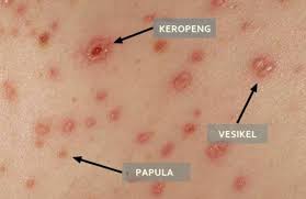 Sampai saat ini selain dengan menjaga imunitas dan kebersihan tubuh. Childhealth 28 Bolehkah Mandi Pada Anak Dengan Cacar Air Steemit