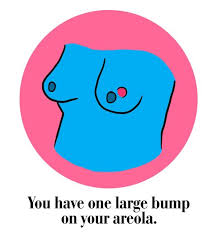 How often does inflammatory breast cancer occur (ibc)? 34 Things Your Breasts Say About Your Health