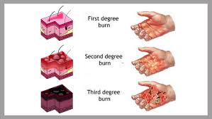 Traditionally, burns are characterized by degree. Texas Personal Injury Claims First Degree Burns