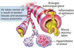 Bronchitis Definition Of Bronchitis By Medical Dictionary Bronchitis Asthma Nursing School Notes