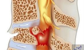 اكتشاف عقار جديد لمعالجة سرطان النخاع العظمي Spinal Cord Injury Treatment Spinal Cord Injury Spinal Cord