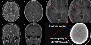 Image result for Thalamotomy