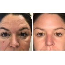 Hola chicas! ✨ ¿Alguien de aquí que tenga M A N C H A S? Conocí un  tratamiento desde casa con VITAMINA C activa🍊 💵 Gastarás poco 💕 Reduces  manchas y recuperas