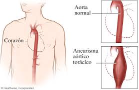 Aunque un aneurisma aórtico torácico puede ser fatal si se rompe, si entiendes los factores de riesgo, los síntomas y las opciones de tratamiento, puedes un aneurisma aórtico torácico se considera grave. Aneurisma Aortico Toracico Medicalrecords Com