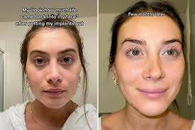 I thought my breast implants were killing me — and I had no idea why