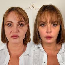 Gaby Spanic's 'Unrecognizable' Before-After Plastic Surgery Pictures  Divides Fans