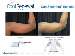 Individuelle beratung und behandlung bei erfahrenen fachärzten und kryolipolyse experten. Before After Cool Renewal Spa
