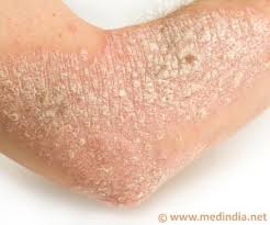 A complete list of discoid eczema medicines in the india with instructions, dosage, and route of administration. Eczema Miracles With Homeopathy