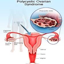 There are several types of ovarian cysts. Polycystic Ovary Syndrome More Than Just Womens Problems Webmed Pharmacy Free Next Day Uk Delivery