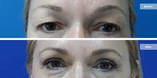Myasthenia gravis is a disorder that causes weakness of the skeletal muscles, which are muscles that the body uses for movement. Ptoza Palpebrala Tratament Naturist Despre ViaÈ›a Din Romania