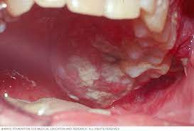 They are sometimes difficult to identify when they involve the base of the tongue — the portion in the back of the mouth — because people do not often inspect this part of the mouth closely. Mouth Cancer Symptoms And Causes Mayo Clinic