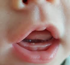 Ah, da kommen bald die zähne. das kann tatsächlich so sein oder auch ganz anders laufen. 1 Zahn Mit 9 Wochen Babyforum At